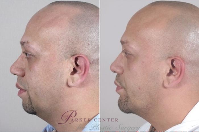Chin Implant Case 953 Before & After View #5 | Paramus, NJ | Parker Center for Plastic Surgery