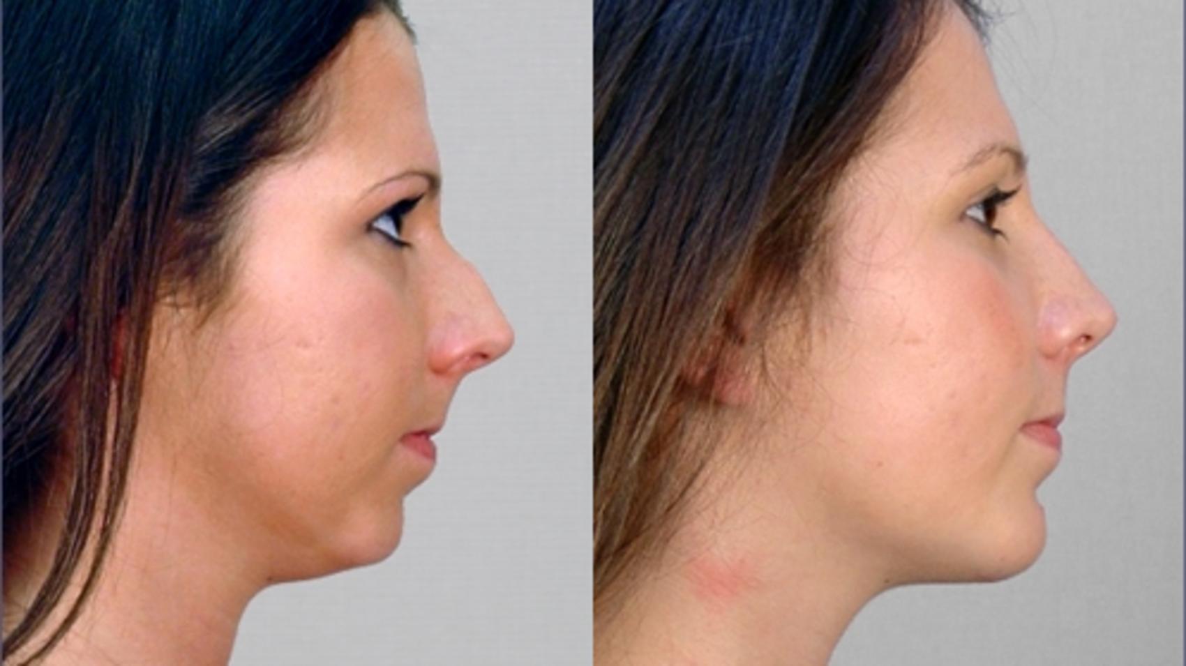 Chin Implants Case 120 Before & After View #2 | Paramus, New Jersey | Parker Center for Plastic Surgery