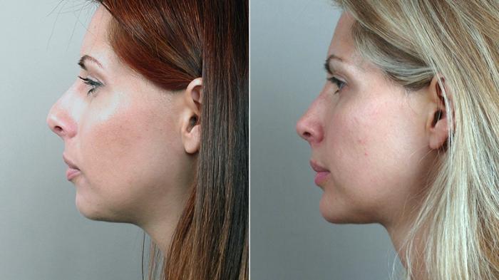 Rhinoplasty Case 125 Before & After View #2 | Paramus, New Jersey | Parker Center for Plastic Surgery