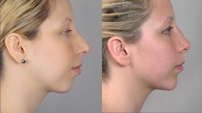 Chin Implants Case 1378 Before & After Left Side | Paramus, New Jersey | Parker Center for Plastic Surgery