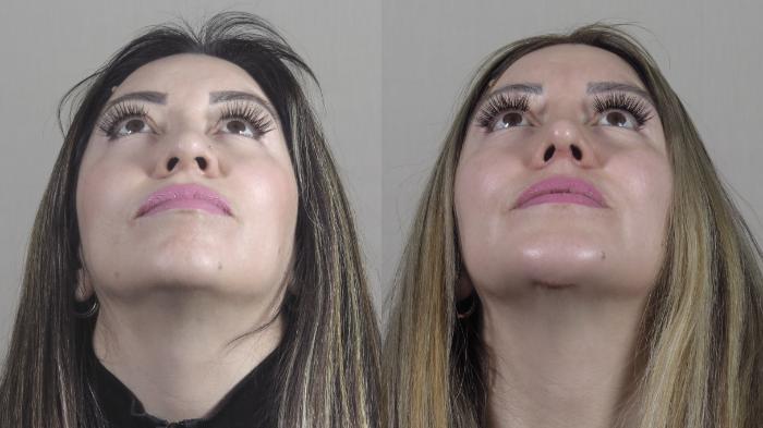 Chin Implants Case 1411 Before & After Looking up | Paramus, New Jersey | Parker Center for Plastic Surgery