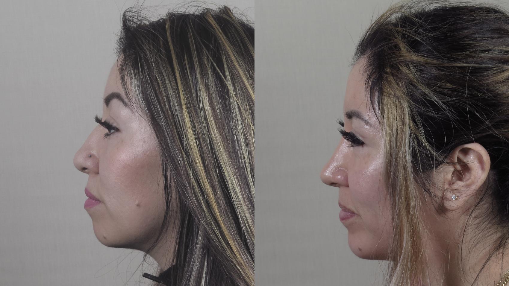 Chin Implants Case 1411 Before & After Side view | Paramus, New Jersey | Parker Center for Plastic Surgery