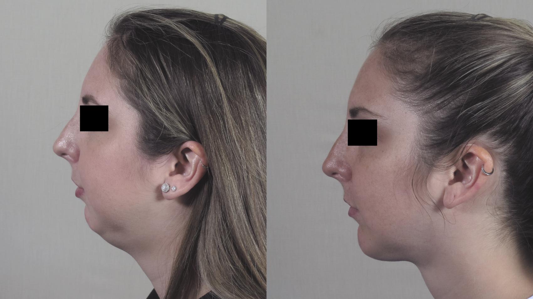 Chin Implants Case 1485 Before & After Left Side | Paramus, New Jersey | Parker Center for Plastic Surgery