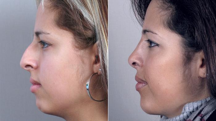 Chin Implants Case 155 Before & After View #2 | Paramus, New Jersey | Parker Center for Plastic Surgery