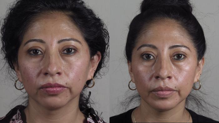 Chin Implants Case 1604 Before & After Front | Paramus, New Jersey | Parker Center for Plastic Surgery