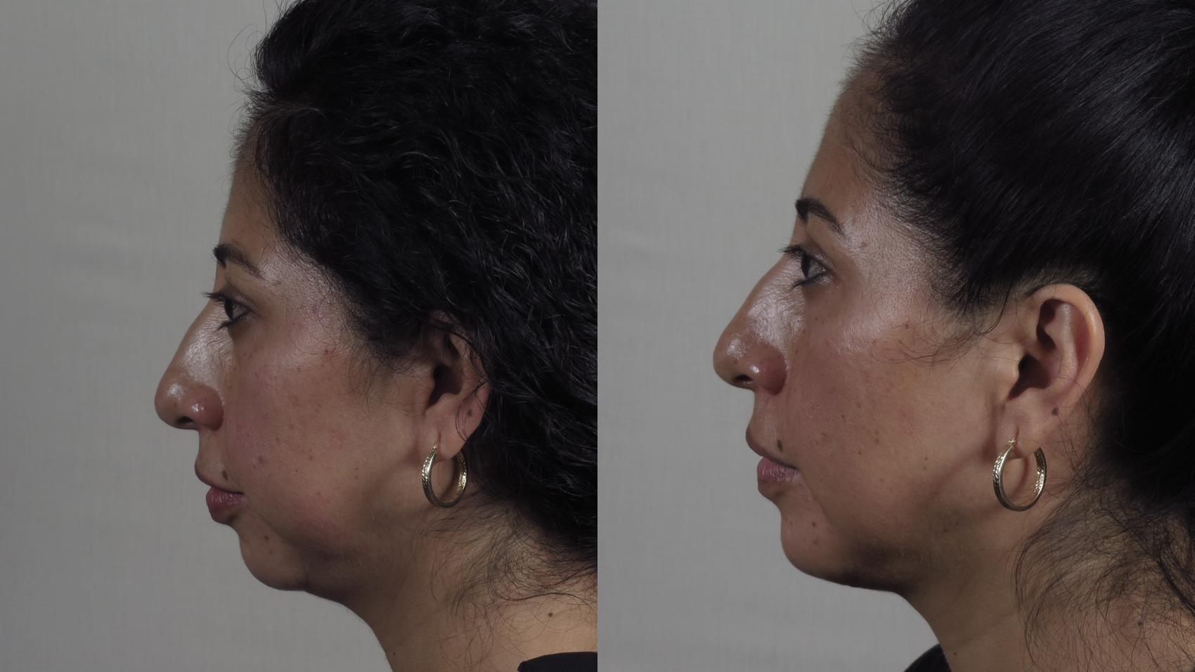 Chin Implants Case 1604 Before & After Left Side | Paramus, New Jersey | Parker Center for Plastic Surgery