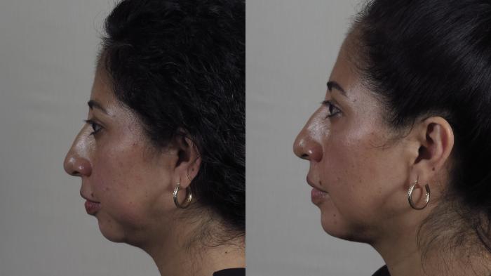 Chin Implants Case 1604 Before & After Left Side | Paramus, New Jersey | Parker Center for Plastic Surgery