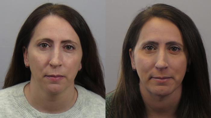 Chin Implants Case 1627 Before & After Front | Paramus, New Jersey | Parker Center for Plastic Surgery