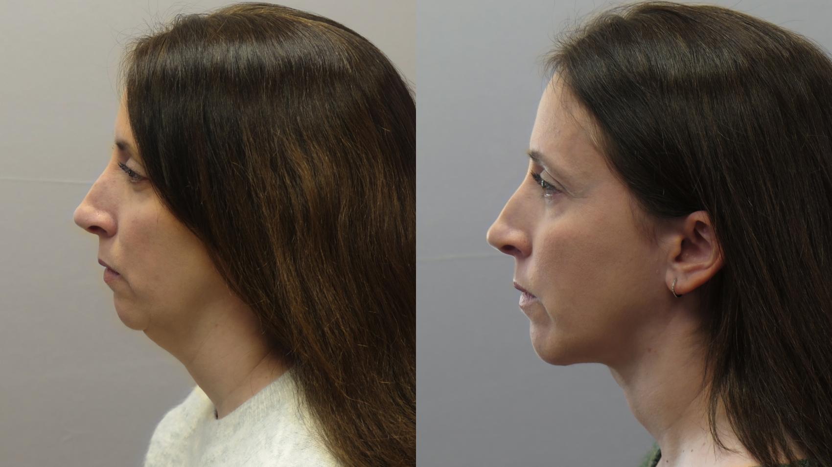 Chin Implants Case 1627 Before & After Left Side | Paramus, New Jersey | Parker Center for Plastic Surgery