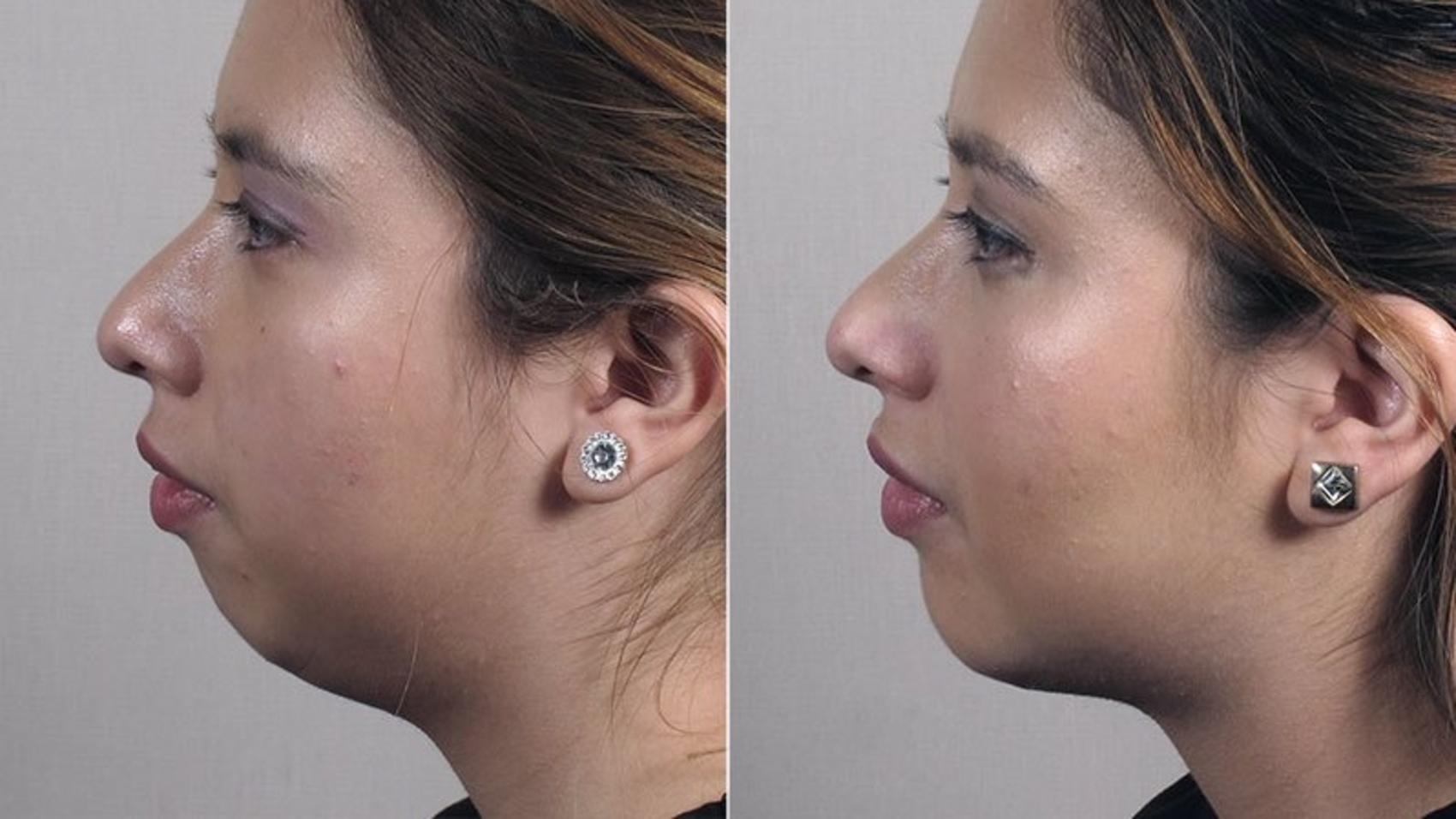 Chin Implants Case 228 Before & After View #2 | Paramus, New Jersey | Parker Center for Plastic Surgery