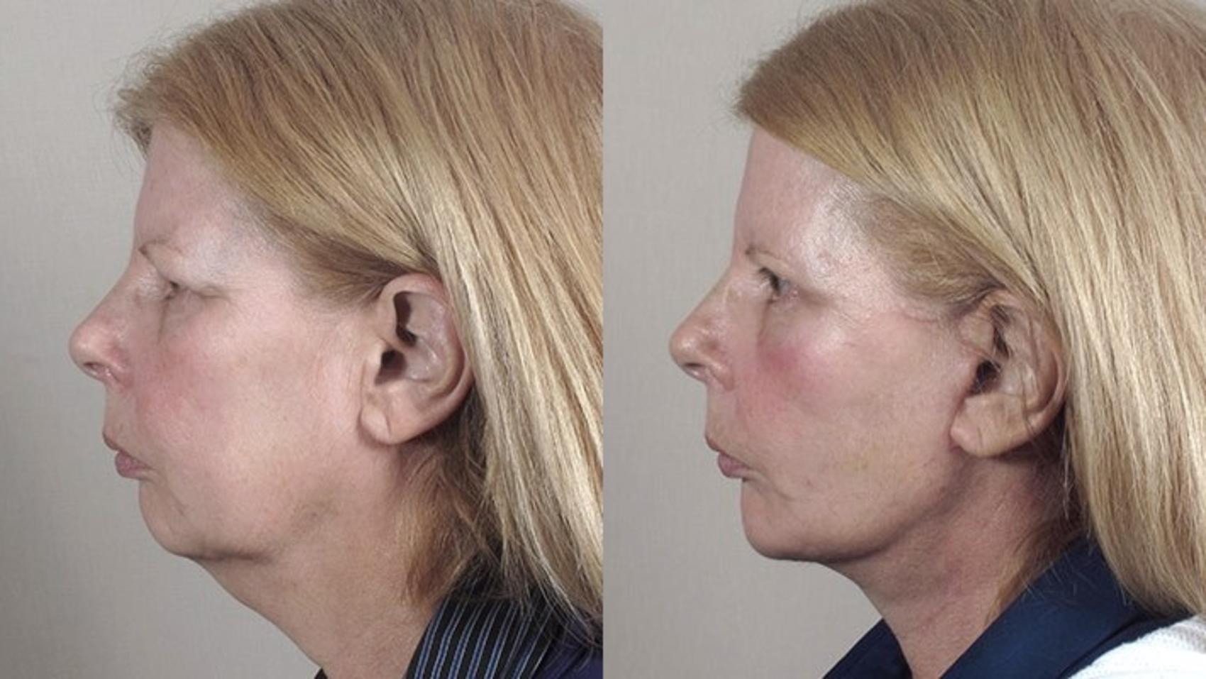 Chin Implants Case 38 Before & After View #2 | Paramus, New Jersey | Parker Center for Plastic Surgery