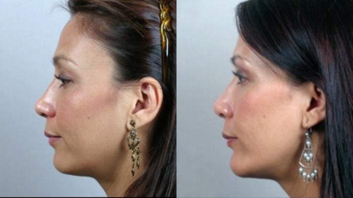 Chin Implants Case 891 Before & After View #4 | Paramus, New Jersey | Parker Center for Plastic Surgery