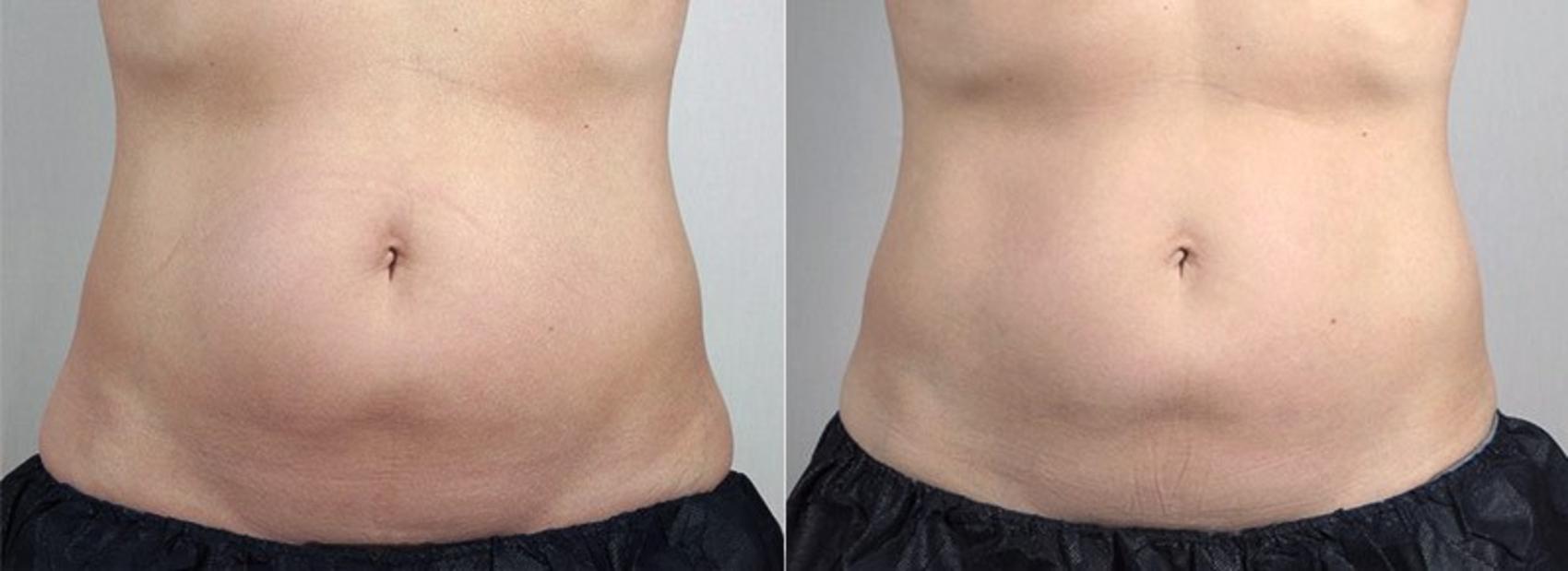 CoolSculpting® Case 835 Before & After View #1 | Paramus, New Jersey | Parker Center for Plastic Surgery