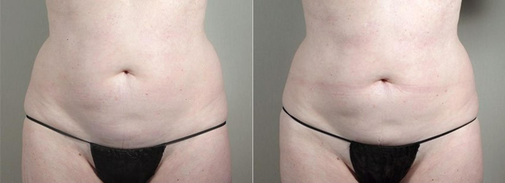 CoolSculpting® Case 836 Before & After View #1 | Paramus, NJ | Parker Center for Plastic Surgery