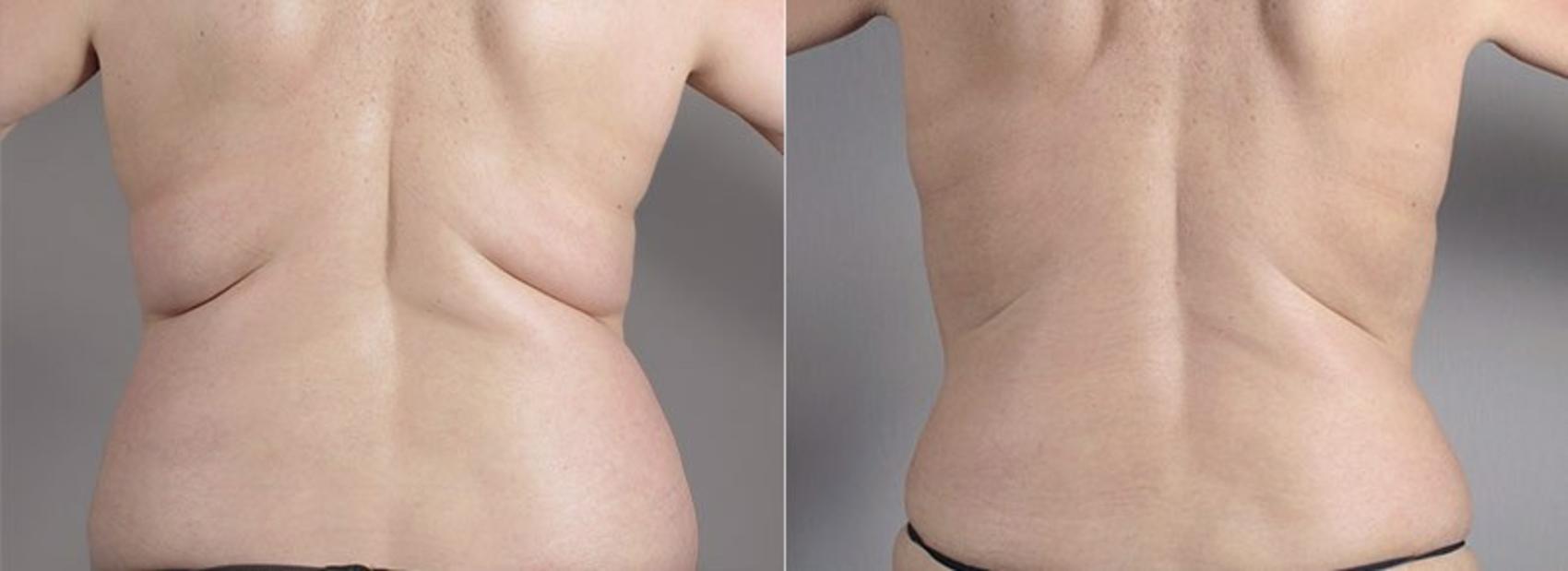 CoolSculpting® Case 837 Before & After View #1 | Paramus, NJ | Parker Center for Plastic Surgery