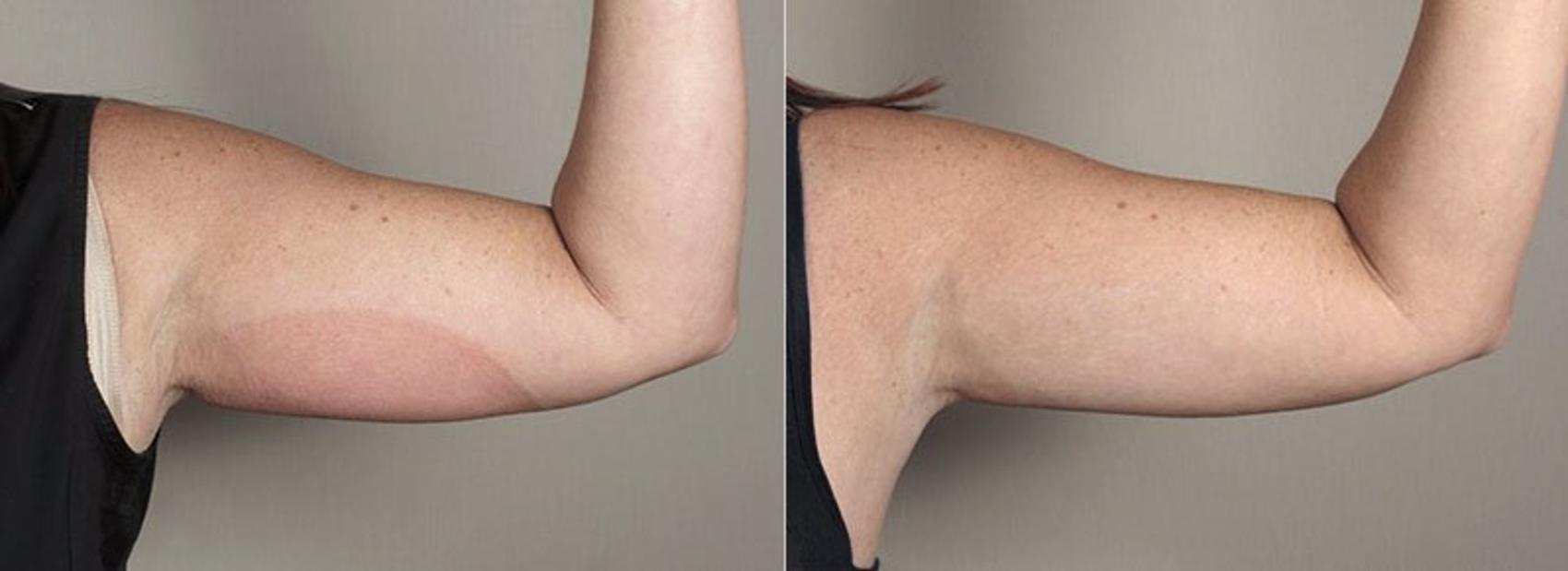 Coolsculpting arms best sale before after