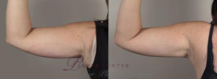 Coolsculpting before and after pictures - Laser & Cosmetic Surgery  Specialist