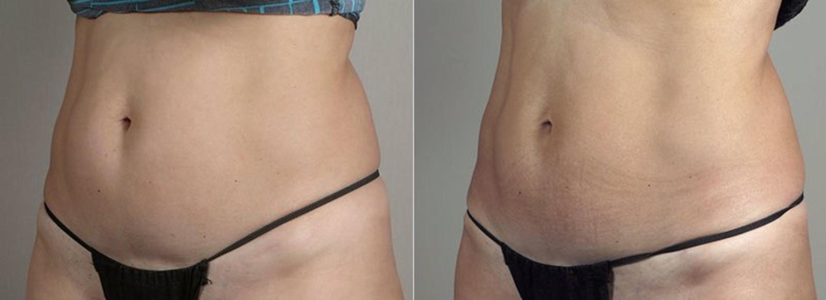 CoolSculpting Paramus Nonsurgical Fat Removal