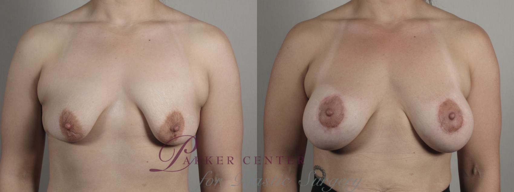 Breast Lift with Implants Case 1011 Before & After Front breast tb | Paramus, NJ | Parker Center for Plastic Surgery