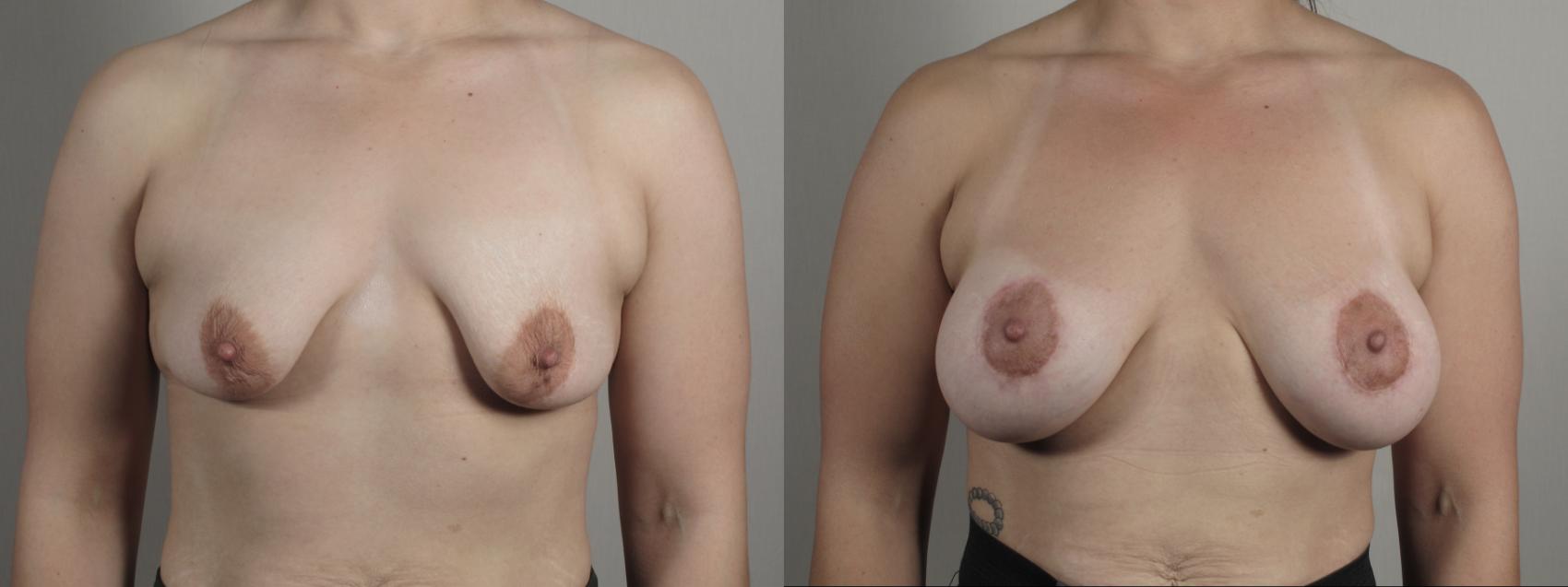 Correction of Tubular Breasts Case 1011 Before & After Front breast tb | Paramus, New Jersey | Parker Center for Plastic Surgery