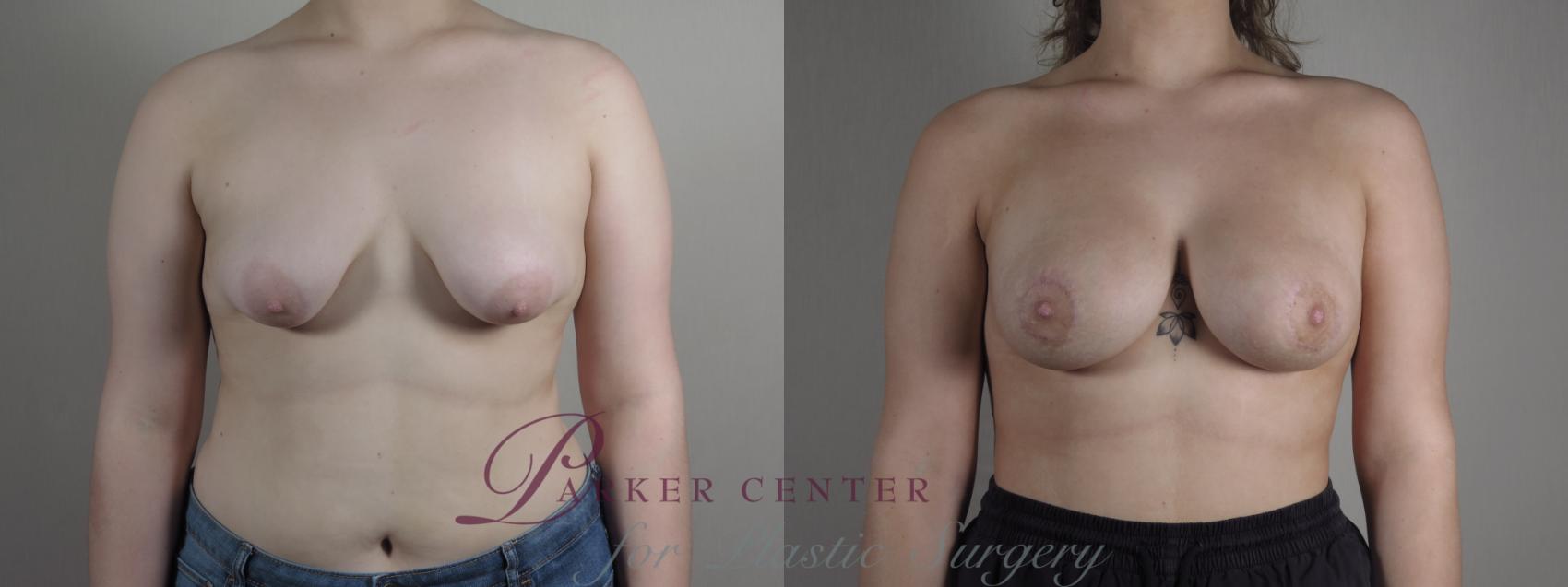 Correction of Tubular Breasts Case 1217 Before & After View #1  | Paramus, NJ | Parker Center for Plastic Surgery