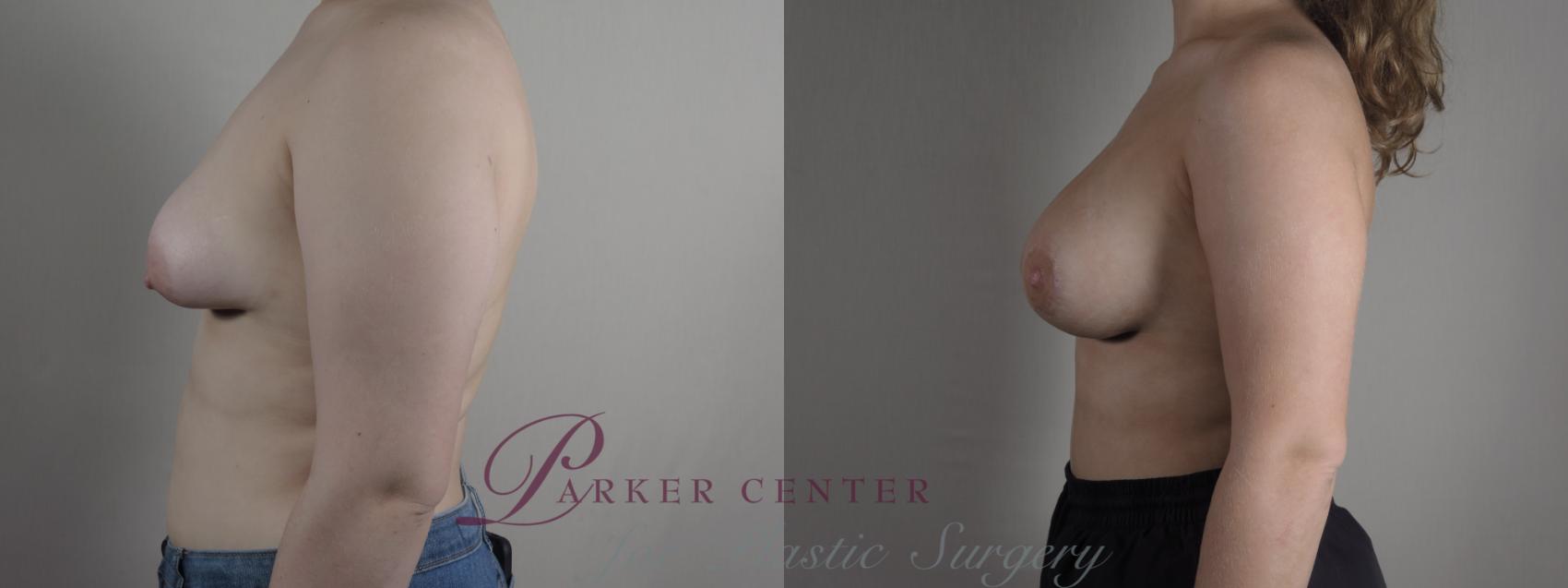 Correction of Tubular Breasts Case 1217 Before & After View #2 | Paramus, NJ | Parker Center for Plastic Surgery