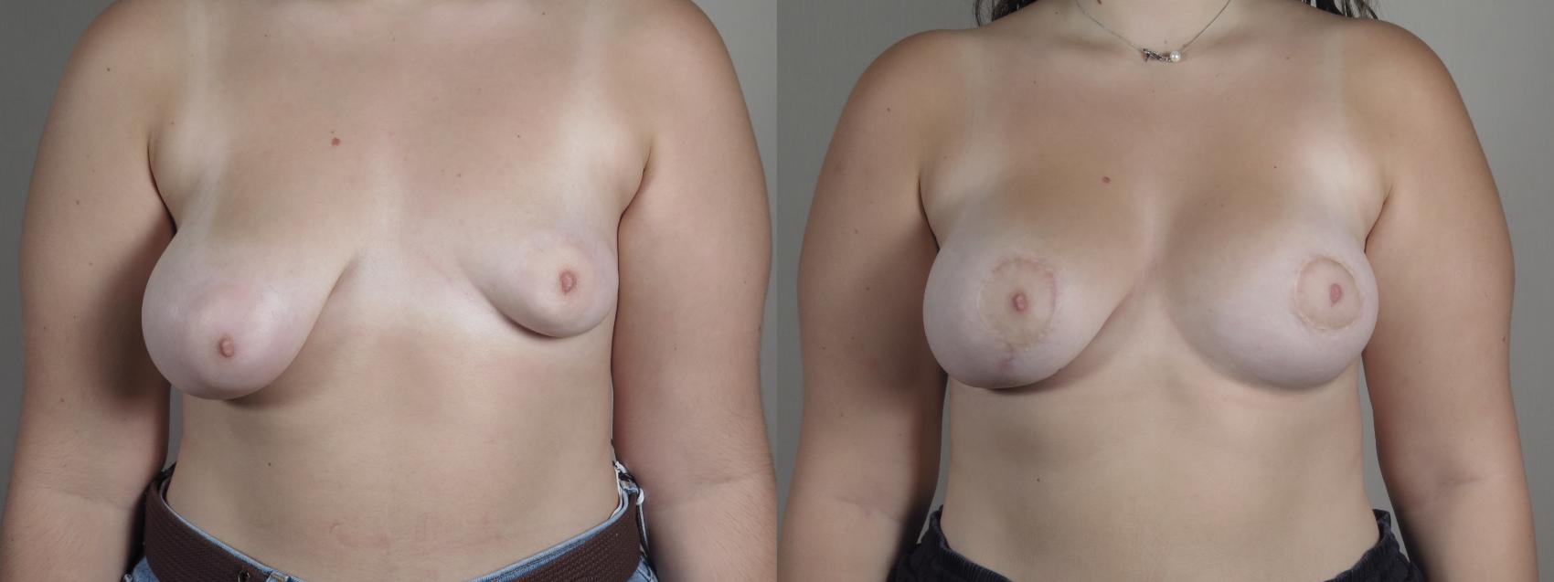 Breast Asymmetry Case 1219 Before & After View #1  | Paramus, NJ | Parker Center for Plastic Surgery