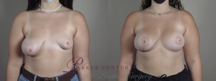 Correction of Tubular Breasts Case 1219 Before & After View #1  | Paramus, NJ | Parker Center for Plastic Surgery