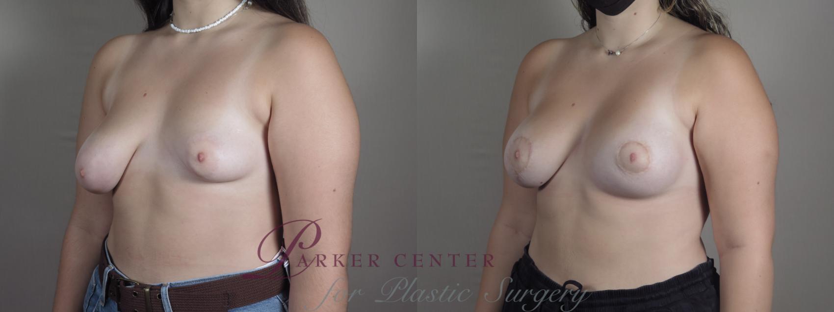 Correction of Tubular Breasts Case 1219 Before & After View #2 | Paramus, NJ | Parker Center for Plastic Surgery