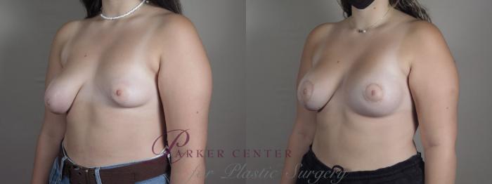 Breast Asymmetry Case 1219 Before & After View #2 | Paramus, NJ | Parker Center for Plastic Surgery