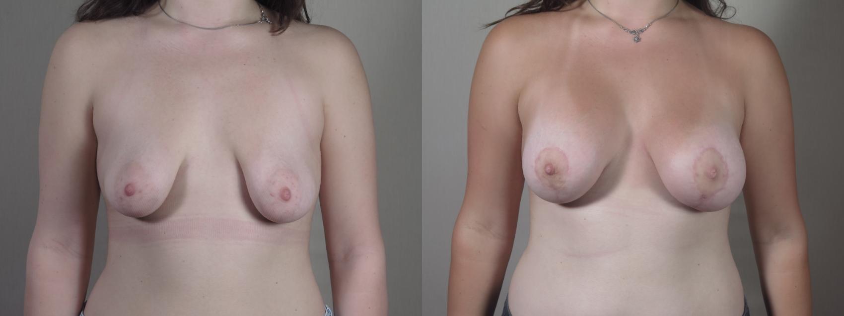 Correction of Tubular Breasts Case 1429 Before & After Front | Paramus, New Jersey | Parker Center for Plastic Surgery