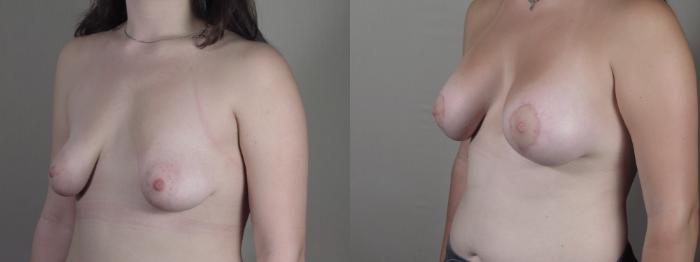 Correction of Tubular Breasts Case 1429 Before & After side view | Paramus, New Jersey | Parker Center for Plastic Surgery