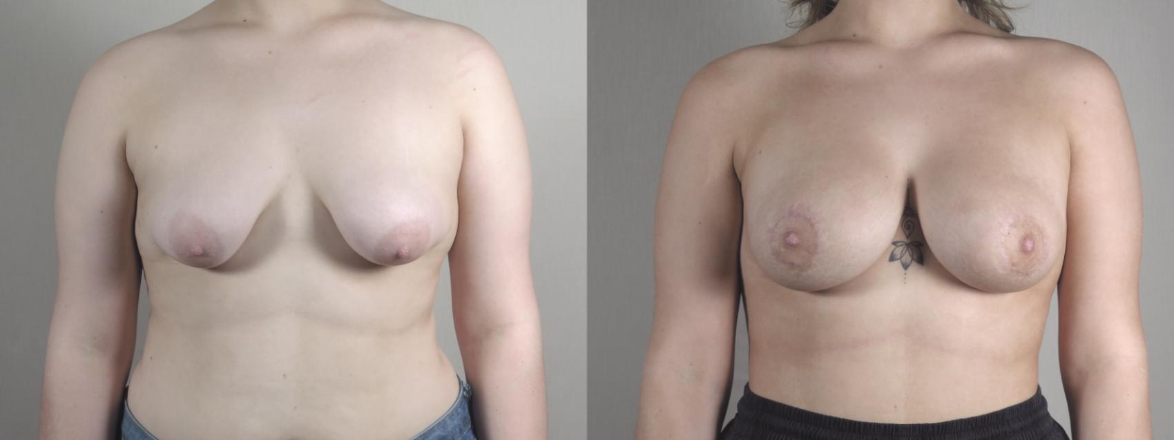 Correction of Tubular Breasts Case 1457 Before & After Front | Paramus, New Jersey | Parker Center for Plastic Surgery