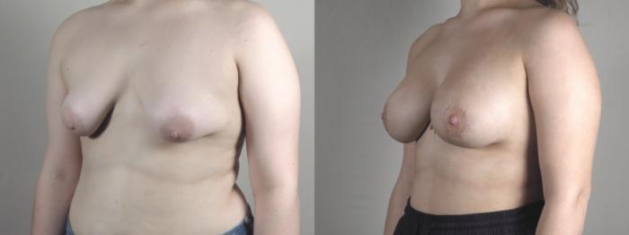 Correction of Tubular Breasts Case 1457 Before & After Left Oblique | Paramus, New Jersey | Parker Center for Plastic Surgery