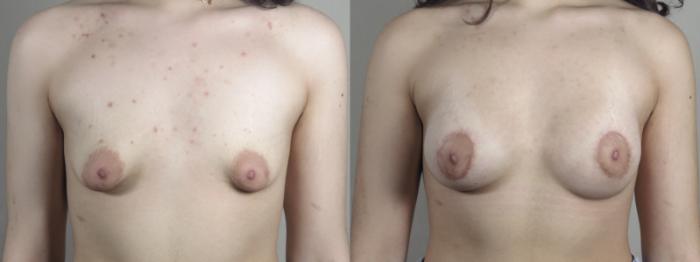 Correction of Tubular Breasts Case 1463 Before & After Front | Paramus, New Jersey | Parker Center for Plastic Surgery