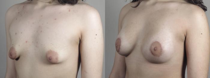 Correction of Tubular Breasts Case 1463 Before & After Left Oblique | Paramus, New Jersey | Parker Center for Plastic Surgery