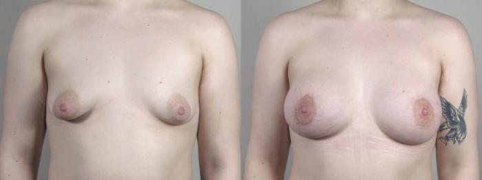 Correction of Tubular Breasts Case 1471 Before & After Front | Paramus, New Jersey | Parker Center for Plastic Surgery