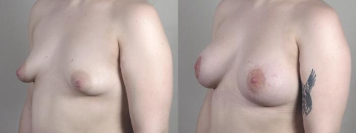 Correction of Tubular Breasts Case 1471 Before & After Left Oblique | Paramus, New Jersey | Parker Center for Plastic Surgery