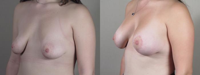 Correction of Tubular Breasts Case 1514 Before & After Left Oblique | Paramus, New Jersey | Parker Center for Plastic Surgery