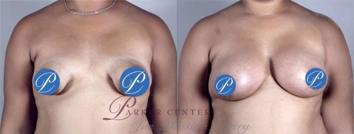 Correction of Tubular Breasts Case 904 Before & After View #5 | Paramus, NJ | Parker Center for Plastic Surgery