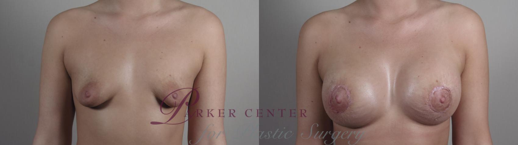 Correction of Tubular Breasts Case 972 Before & After Front | Paramus, NJ | Parker Center for Plastic Surgery