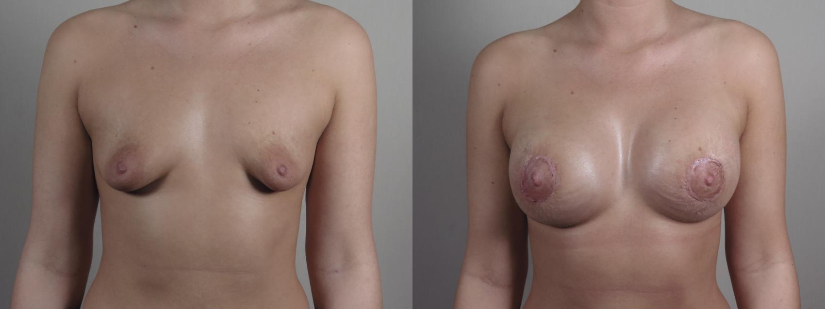 Correction of Tubular Breasts Case 972 Before & After Front | Paramus, NJ | Parker Center for Plastic Surgery