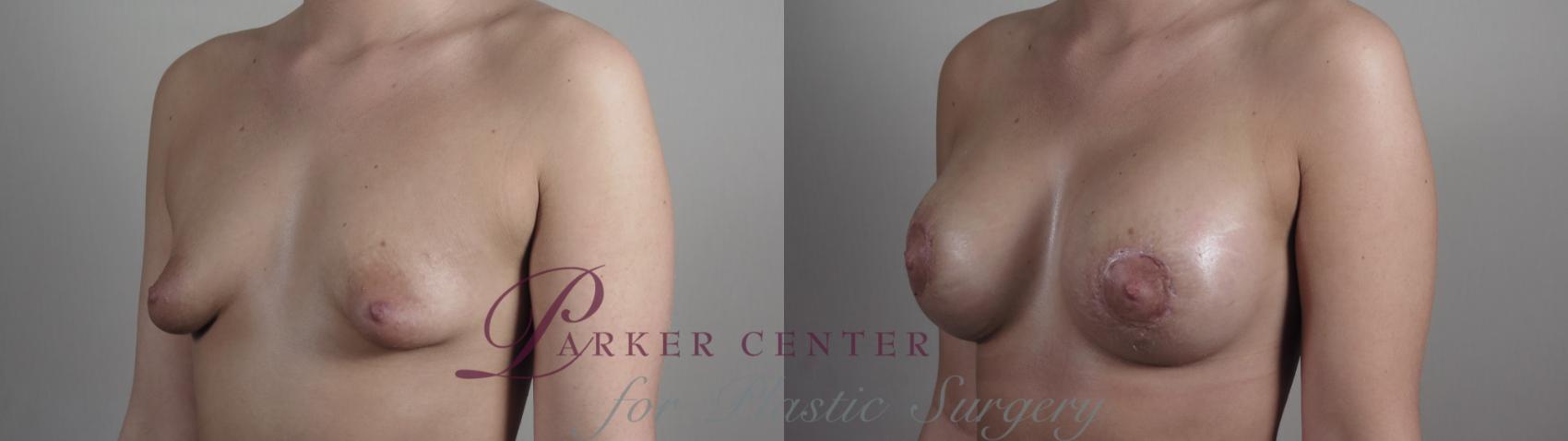 Breast Lift with Implants Case 972 Before & After Right Oblique | Paramus, NJ | Parker Center for Plastic Surgery