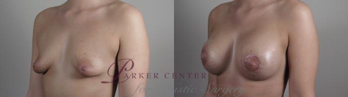 Correction of Tubular Breasts Case 972 Before & After Right Oblique | Paramus, NJ | Parker Center for Plastic Surgery