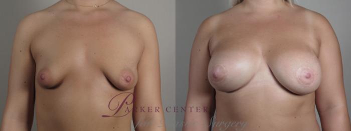 Correction of Tubular Breasts Case 973 Before & After Front breast view | Paramus, NJ | Parker Center for Plastic Surgery