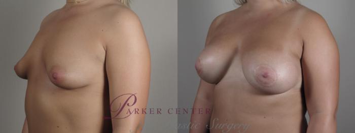 Correction of Tubular Breasts Case 973 Before & After right oblique breast  | Paramus, NJ | Parker Center for Plastic Surgery