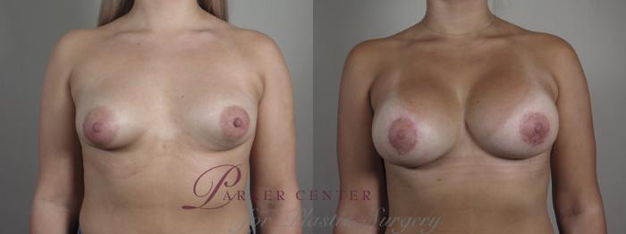 Correction of Tubular Breasts Case 974 Before & After front 2 | Paramus, NJ | Parker Center for Plastic Surgery