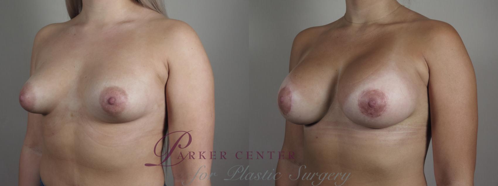 Correction of Tubular Breasts Case 974 Before & After right oblique 2 | Paramus, NJ | Parker Center for Plastic Surgery