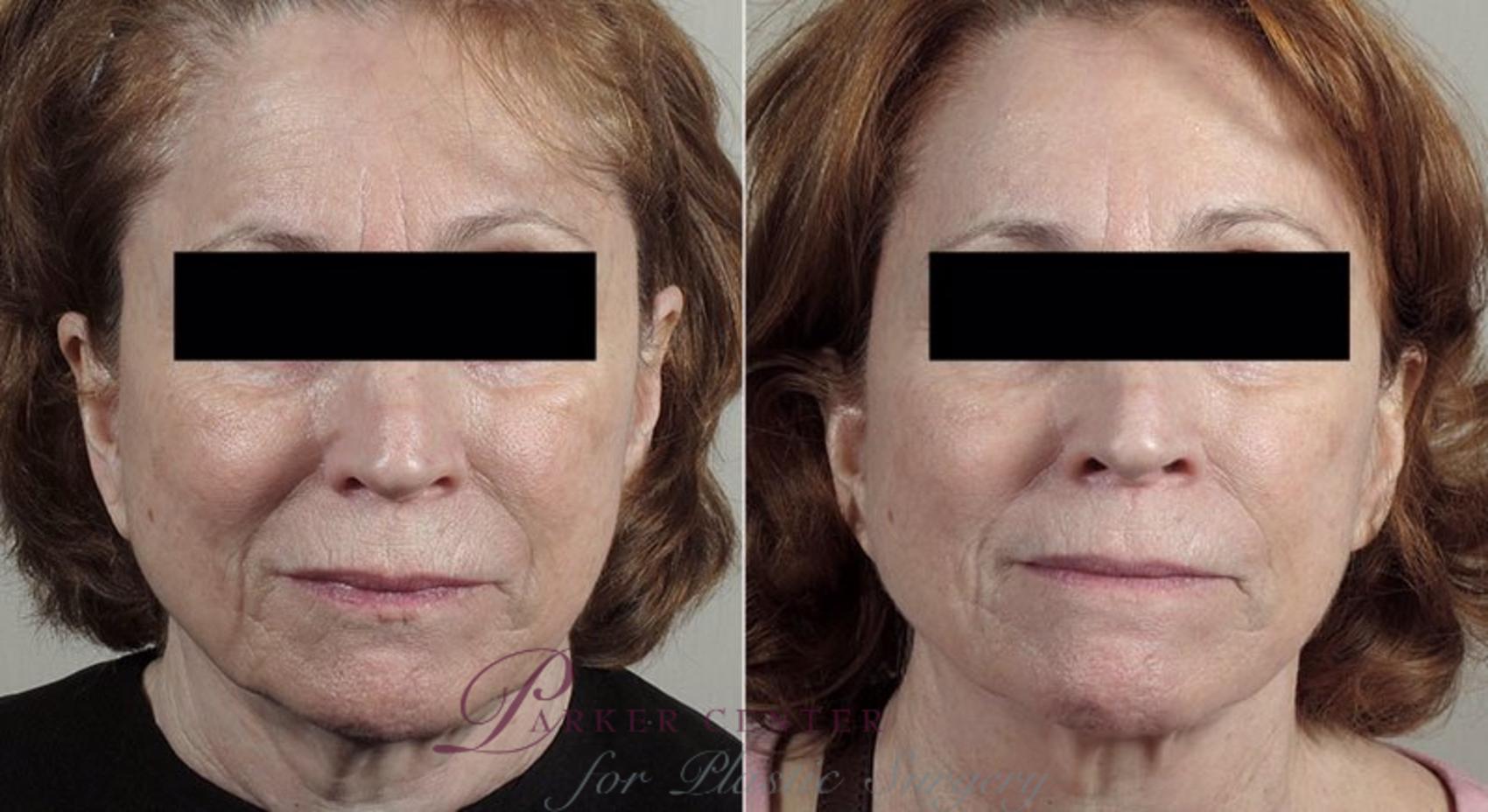 Dermabrasion Case 323 Before & After View #1 | Paramus, New Jersey | Parker Center for Plastic Surgery