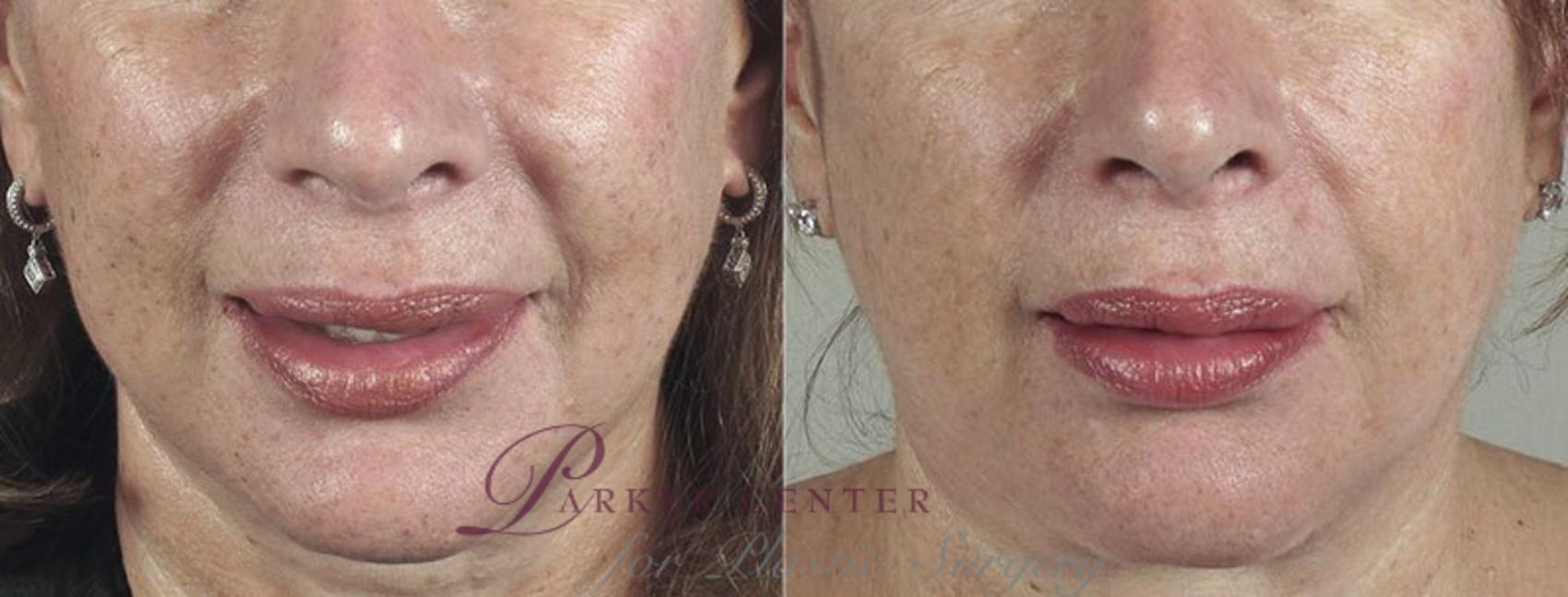 Dermal Fillers Case 291 Before & After View #1 | Paramus, New Jersey | Parker Center for Plastic Surgery